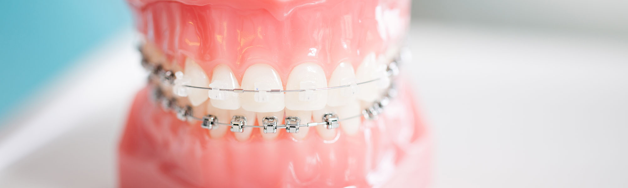 Orthodontics FAQs